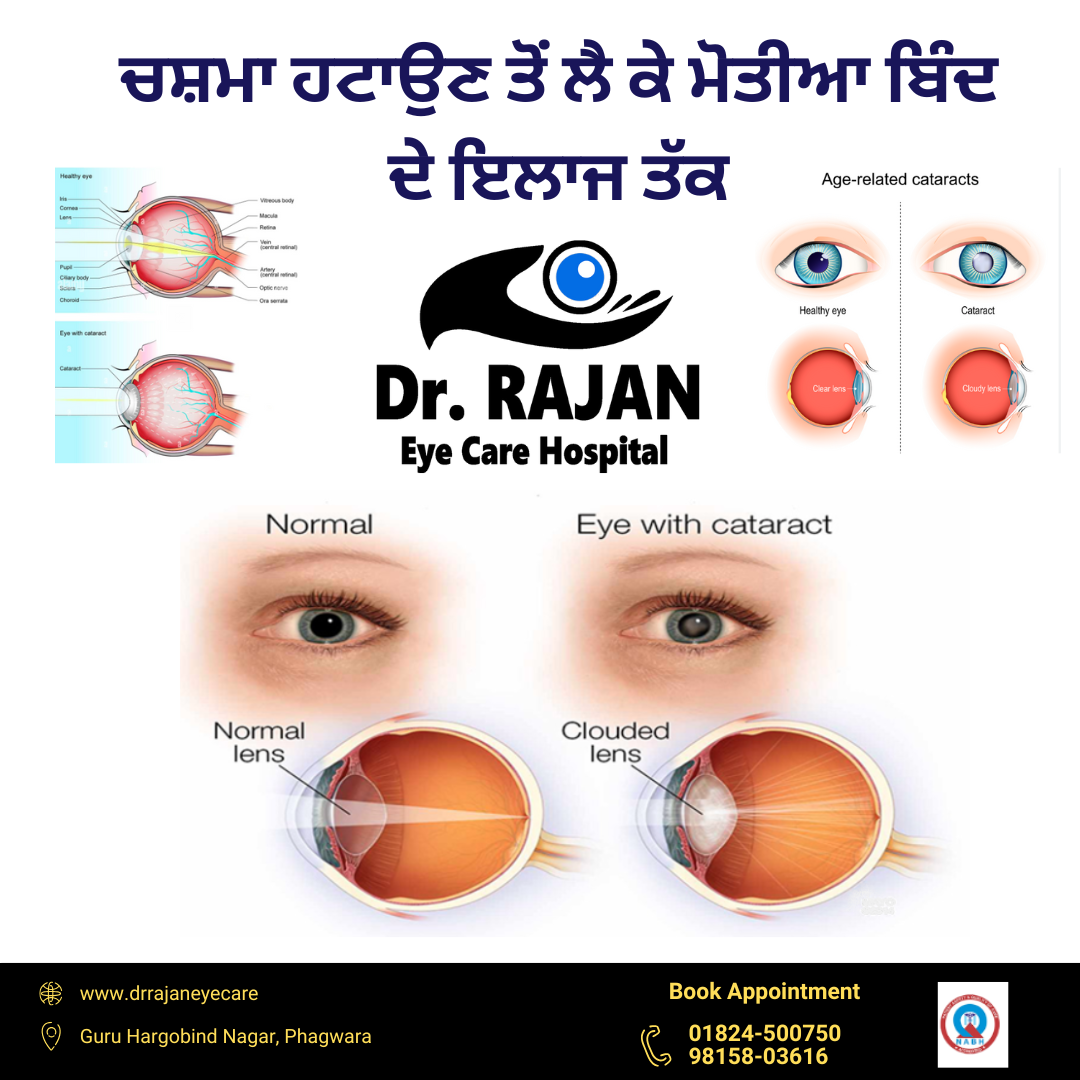 Cataract Surgery